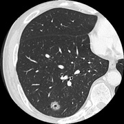 高分解能肺単純CT画像