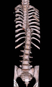 脊椎単純3DCT画像