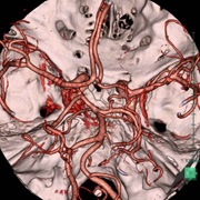 脳血管3D-CTA画像