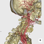 頸部血管3D-CTA画像