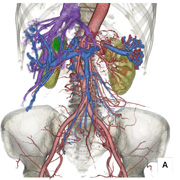 腹部動静脈3D-CTA画像