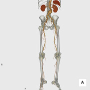 下肢動脈3D-CTA画像