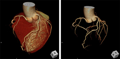 冠動脈3D画像