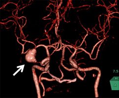 脳動脈瘤3D-CTA画像
