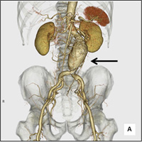 腹部動脈瘤3D-CTA画像