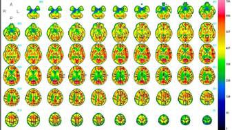 脳血流シンチの画像
